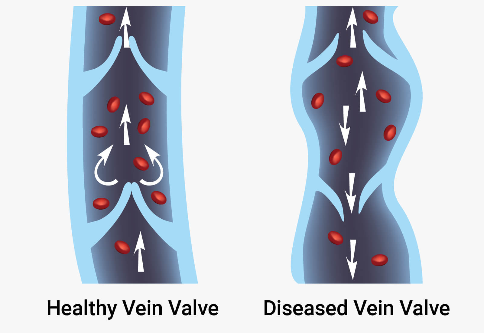 The anatomy of a vein showing healthly veins, where the blood can only flow one way, and an unhealthy vein where the blood is able to flow both ways.